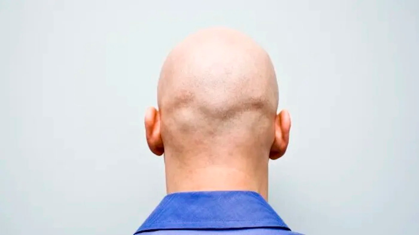 稱男性為「Bald」是言語性汙辱